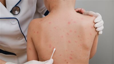 أمريكا تسجل أول حالة وفاة بفيروس جدري القرود