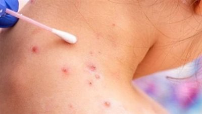 أمريكا تعلن أول عن حالة وفاة بسبب جدري القرود