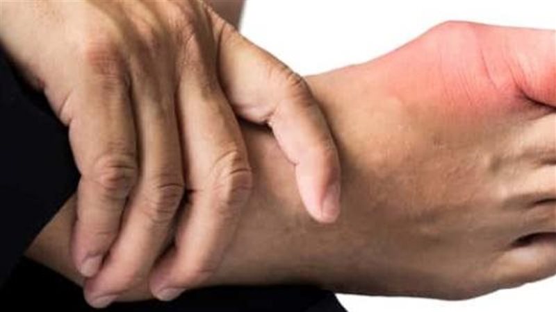 أعراض النقرس