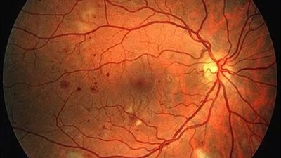 10 أعراض لأمراض شبكية العين 