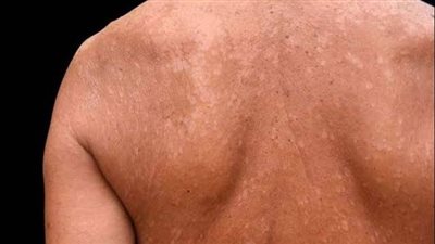 منها الهرمونات والبشرة الدهنية، أعراض وأسباب التينيا