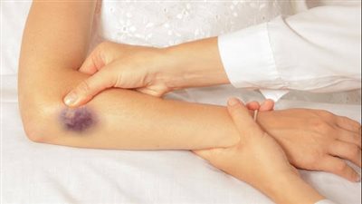 ما هو مرض الهيموفيليا؟ 