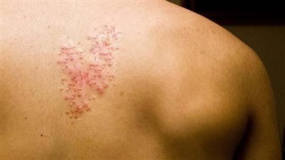 كل ما تريد معرفته عن الفيروس المسبب للحزام الناري وسعر لقاحه في مصر