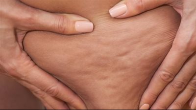 وصفة طبيعية تقضي على السيلوليت بالجسم