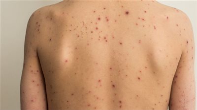 الصحة العالمية تعلن جدري القرود حالة طوارئ دولية