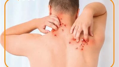 الصحة تحذر المواطنين من أعراض جدري القرود: يجب الذهاب لأقرب مستشفى حميات