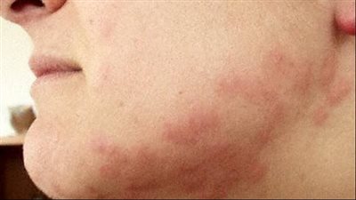 أعراض تينيا اللحية 