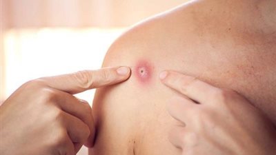 اكتشاف أول حالة مصابة بجدري القرود في أوكرانيا