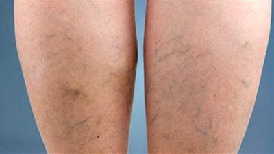 طرق علاج الدوالي.. الأعراض وأسباب الإصابة 