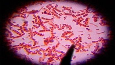 بعد الفطر الأسود.. عدوى خطيرة تضرب العراق وتسبب الوفاة