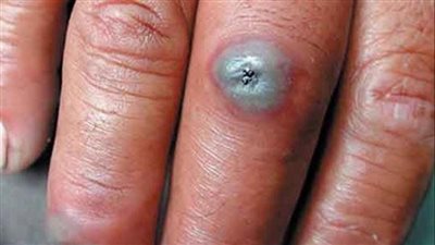 طبيعة مرض الجمرة الخبيثة.. جرثومة تصنع منها الأسلحة البيولوجية لسهولة نشرها