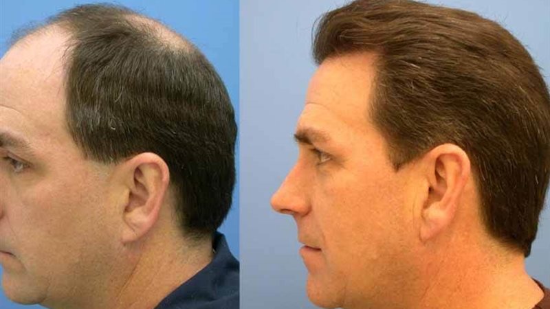 عمليات زرع الشعر