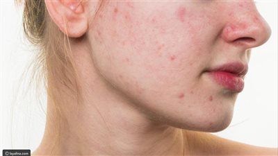 لعلاج حب الشباب.. 7 أعشاب طبيعية تناولها يوميا