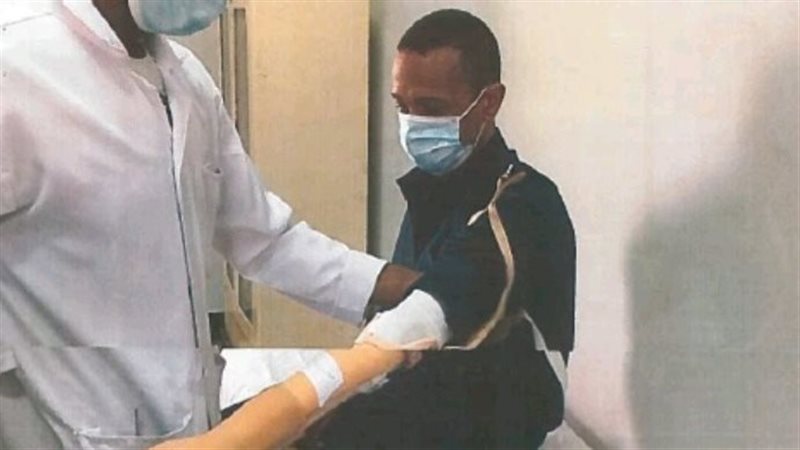 تركيب أطراف صناعية