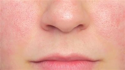 عصير الليمون والأناناس حل سحري للقضاء على المسام الواسعة