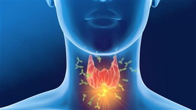 أعراض فرط نشاط الغدة الدرقية 
