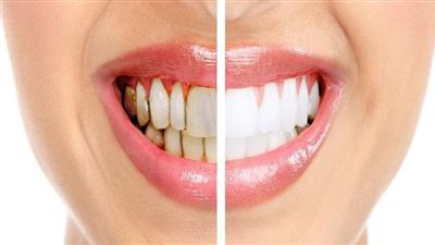 كيف يحدث تسوس الأسنان؟ الصحة تجيب 