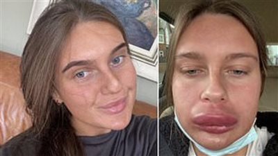 عملية تجميل فاشلة تحول شفاه فتاة إلى 