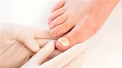 علاج فطريات الأظافر وأسباب الإصابة وطرق الوقاية منها