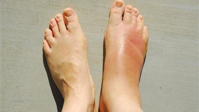 منها الحمل والسكري، أسباب تورم القدمين 