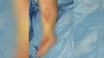 مصابة بحروق وجروح بالغة.. طفلة تتعرض لاعتداء وحشي من والدها وزوجته ببورسعيد | صور