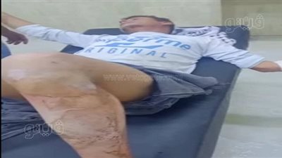 بسبب كرسي.. عاطل يصيب مواطنا بجرح ذبحي ويسكب مادة حارقة على آخر بالشرقية | صور