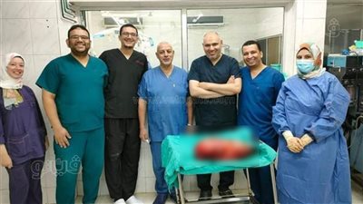 نجاح فريق طبي بأورام طنطا في استئصال ورم ضخم من بطن طفلة