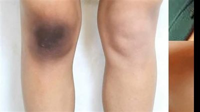 كل ما تودين معرفته عن اسمرار الركبة وطرق العلاج 