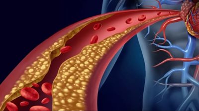 احذر من علامة خطيرة للموت المفاجئ.. باحث بطب نيويورك يكشف سر القاتل الصامت 