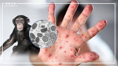 هل يتحول جدري القرود إلى جائحة وبائية؟ استشاري بالمصل واللقاح يفجر مفاجأة