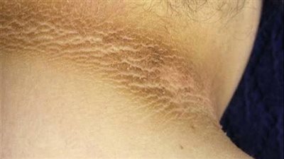 ما هو الشواك الأسود وأسباب ظهوره 