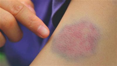 ما هي عوامل خطر تجلط الدم عند الحامل؟ 