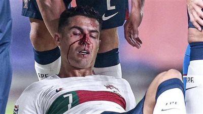 قائد البرتغال رفض الخروج رغم النزيف.. تفاصيل إصابة رونالدو أمام التشيك | فيديو
