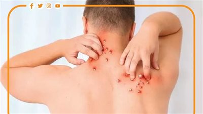 آخر تطورات الحالة الصحية لثاني مصاب بفيروس جدري القرود