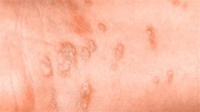 ما هو مرض الحزاز الجلدي.. تعرف على أهم الأعراض 