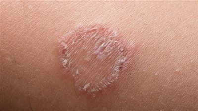 هاني الناظر: القوباء تصيب شعر الأطفال وتنتشر في المدارس| فيديو