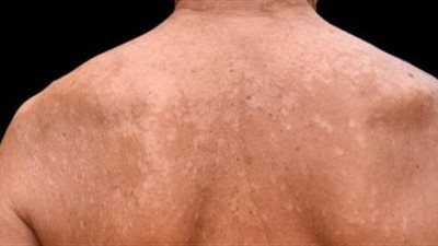 الناظر: التينيا أبرز الأمراض المنتشرة فى فترة تغيير الفصول | فيديو