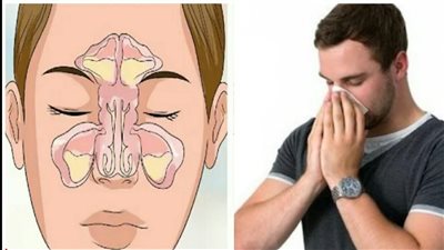 أعراض التهاب الجيوب الأنفية.. وأفضل طرق العلاج 
