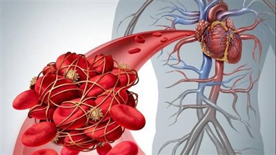 الرقابة الصحية: الجلطات الوريدية القاتل الصامت للمرضى | فيديو
