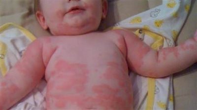  أسباب حساسية الحليب عند الأطفال.. والأعراض وطرق العلاج