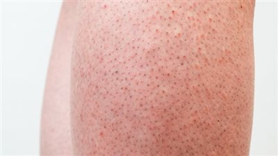 كيف تتخلصين من جلد الوزة بشكل نهائي ؟ 