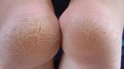 5 علاجات سهلة لتشققات القدم