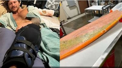 راكب أمواج ينجو من فكي قرش عملاق بأعجوبة