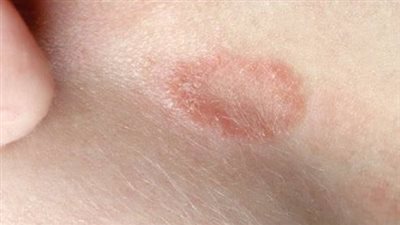 5 نصائح للحماية من فطريات التينيا الجلدية 