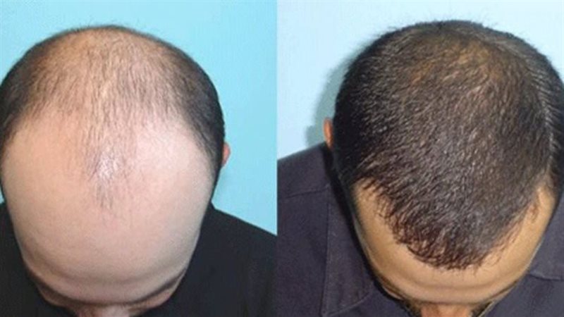 علاج محتمل لمشكلة