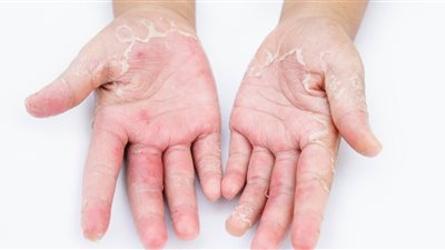 تتضمن أنواعًا قاتلة.. قائمة الصحة العالمية لمسببات الأمراض الفطرية