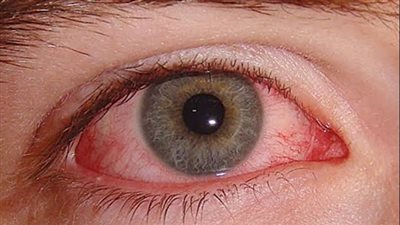 5 أعراض لارتفاع ضغط العين.. تعرف عليها 