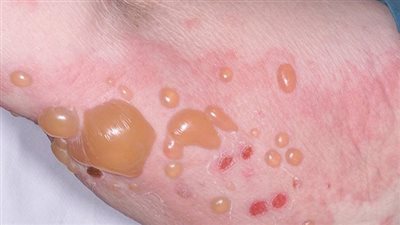 في اليوم العالمي له.. مؤسسة ياسمين تقدم العلاج بالمجان لمرضى انحلال الجلد الفقاعي