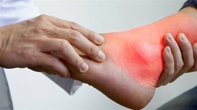 أعراض النقرس وأسباب الإصابة وأفضل علاج من الطبيعة