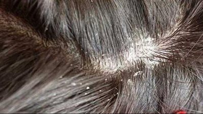 أعراض مرض الصدفية في فروة الرأس